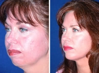 Üst Çene Geriliği Belirtileri ve Tedavisi