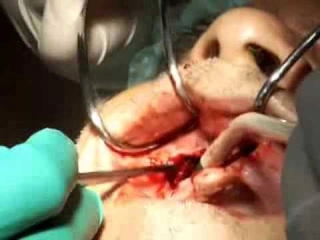 Alt Çene Kisti Ameliyatı Riskleri ve Sonrası