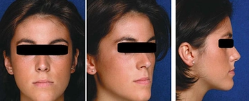 Alt Çene Önde Belirtileri ve Tedavisi