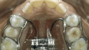 Üst Çene Genişletme Nasıl Yapılır?